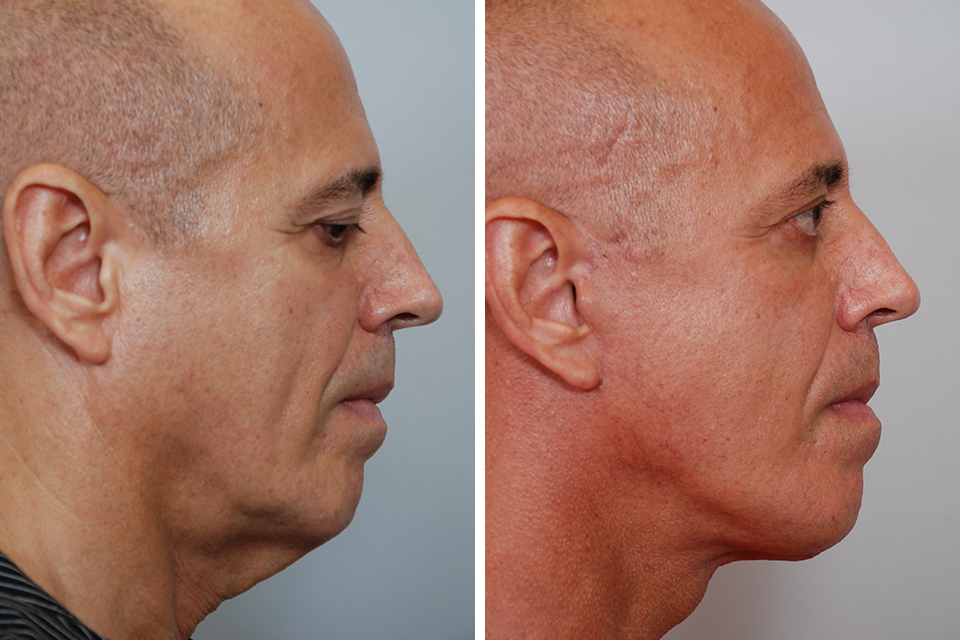 Blepharoplasty case #3416