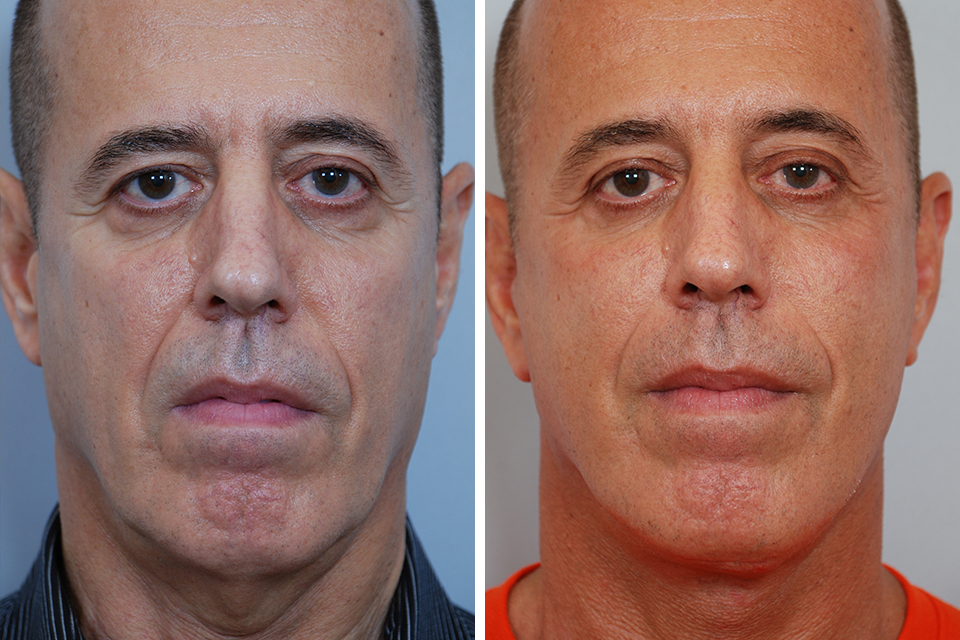 Blepharoplasty case #3416