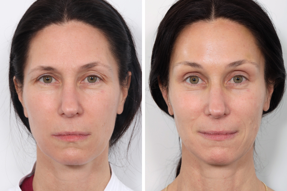 Brow Lift case #3660