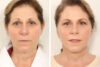 Blepharoplasty case #4430 slider thumbnail