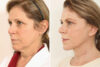 Blepharoplasty case #4430 slider thumbnail