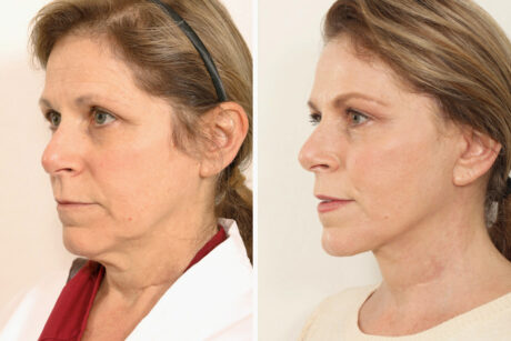 Blepharoplasty case #4430