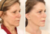 Blepharoplasty case #4430 slider thumbnail