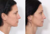 Brow Lift case #3660 slider thumbnail
