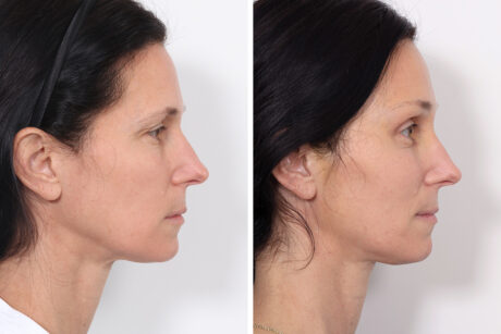 Brow Lift case #3660
