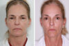 Brow Lift case #3717 slider thumbnail