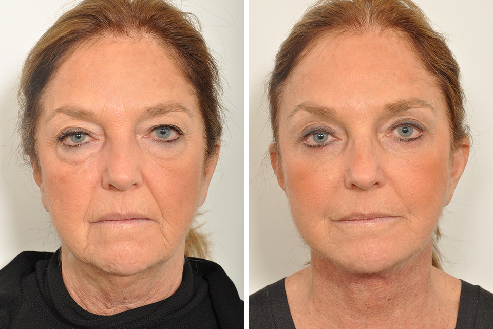 Brow Lift case #3715