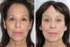 Brow Lift case #3724 slider thumbnail