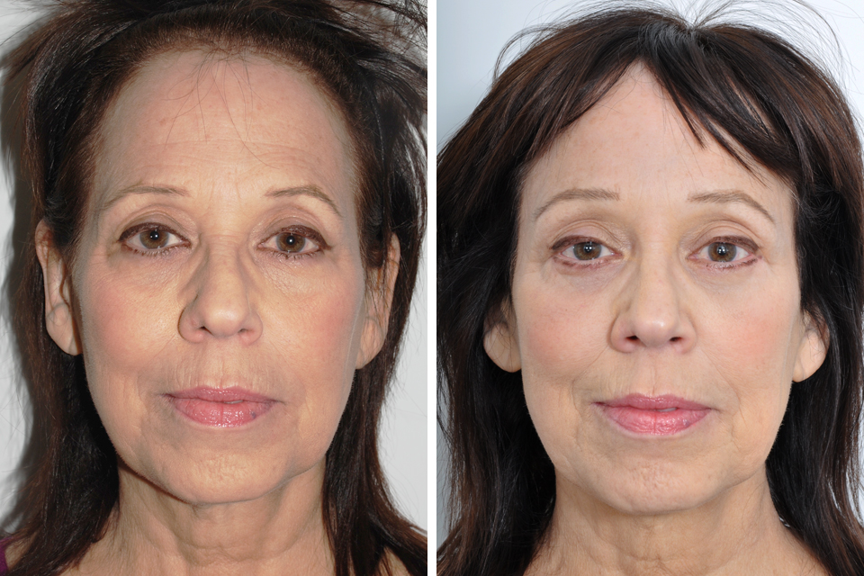 Brow Lift case #3724