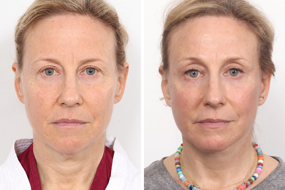 Blepharoplasty case #3766