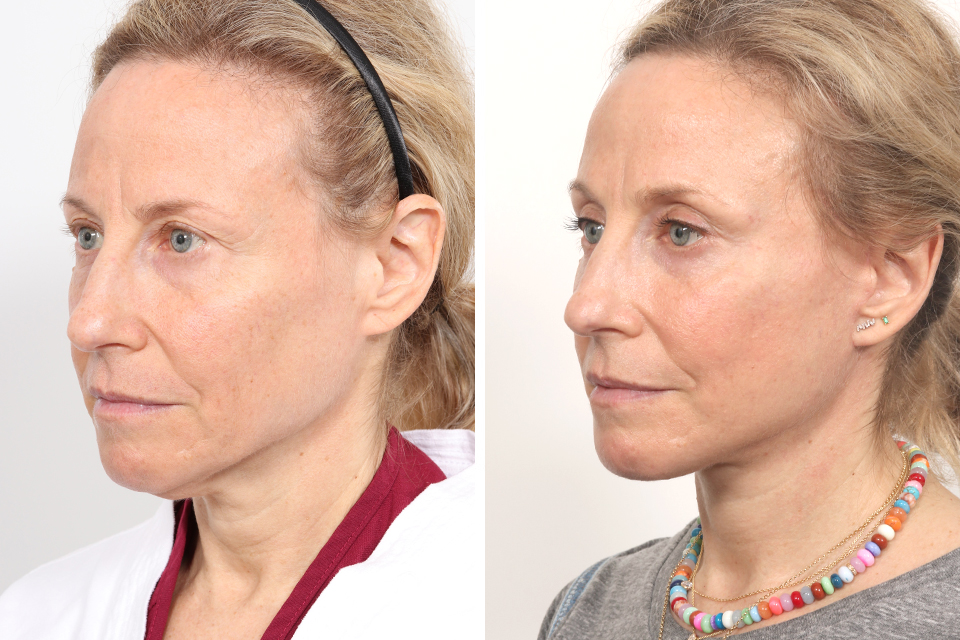 Blepharoplasty case #3766