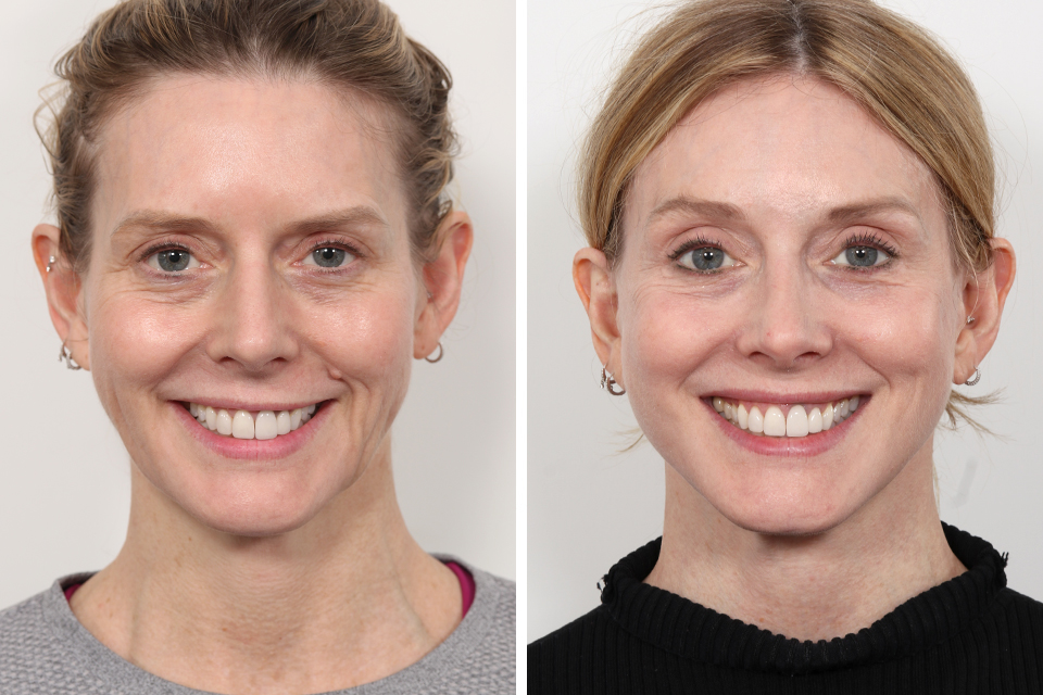 Brow Lift case #3663