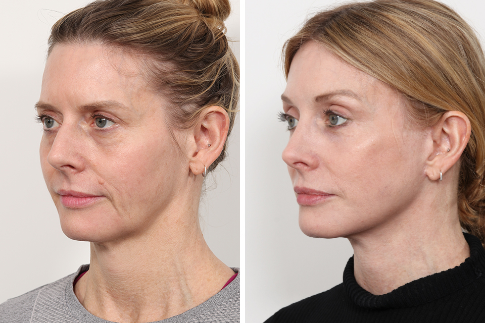 Brow Lift case #3663