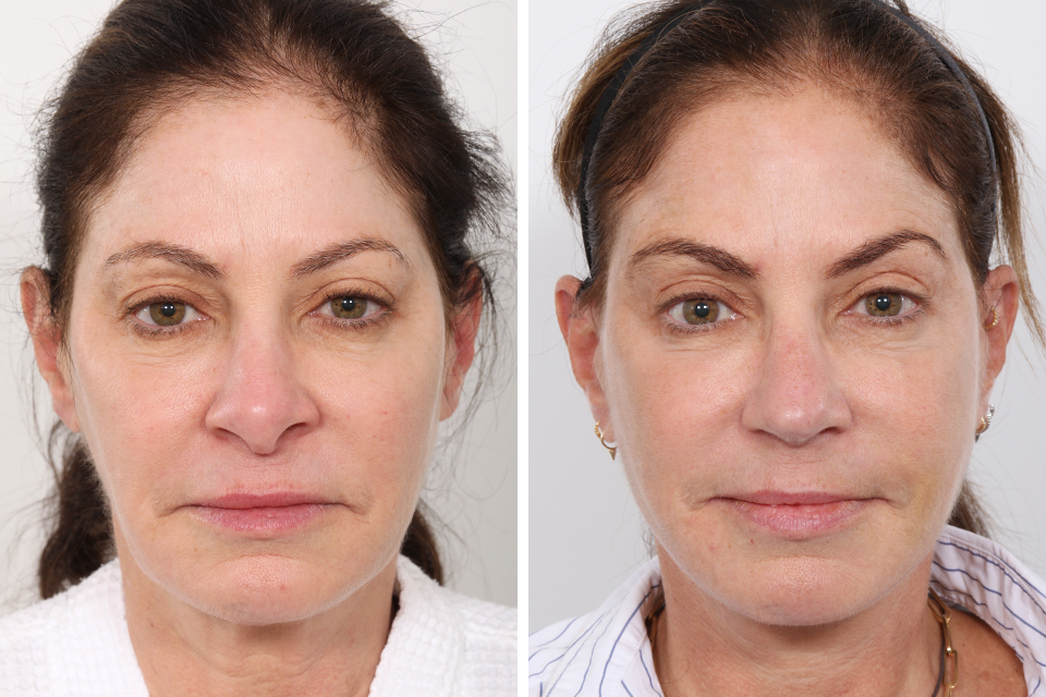 Facelift case #3837