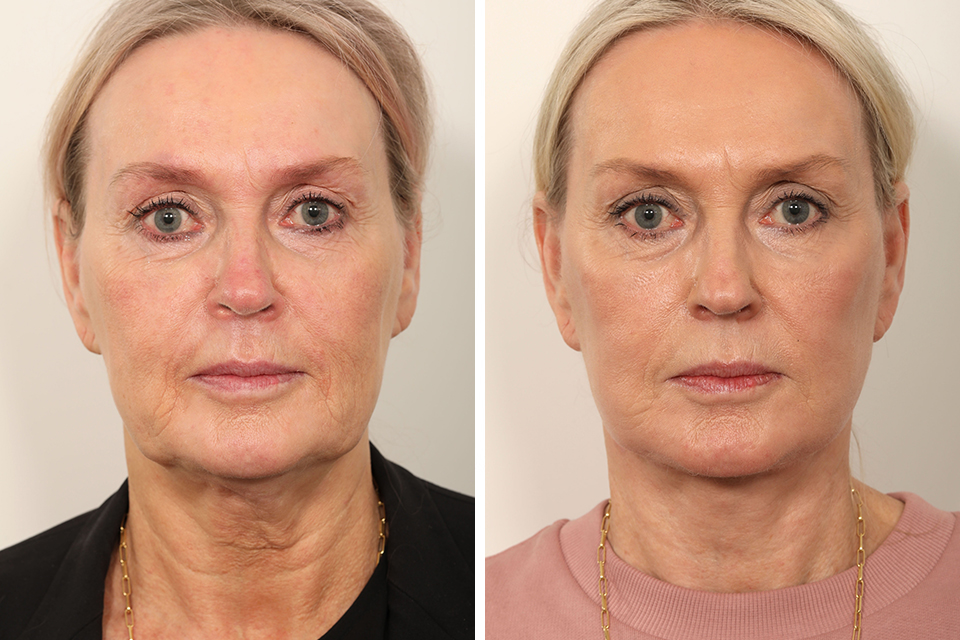 Facelift case #3833