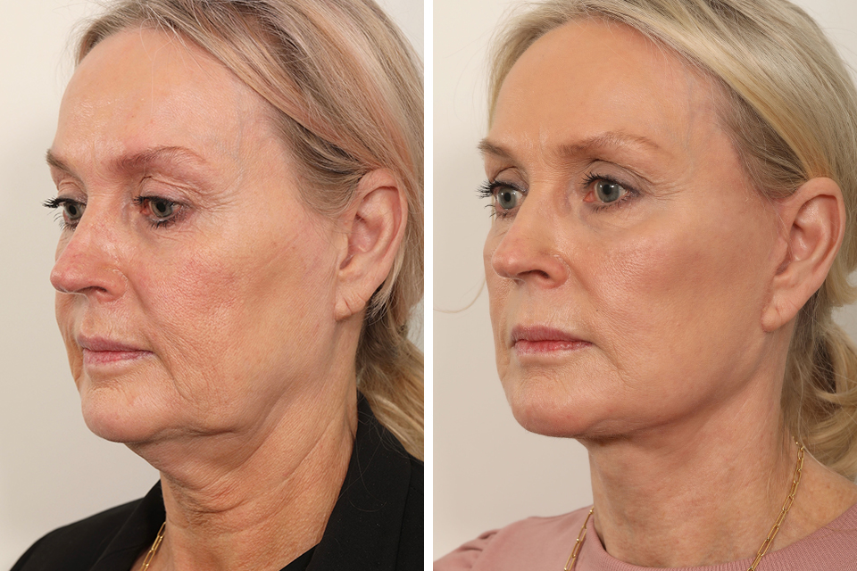 Facelift case #3833