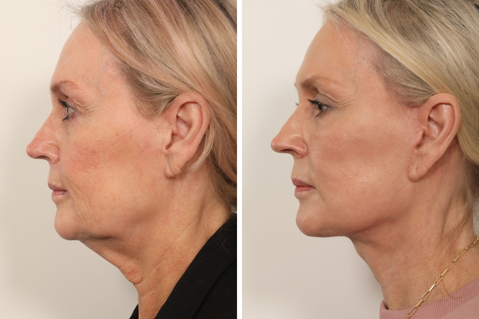 Facelift case #3833