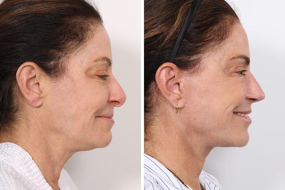Facelift case #3837