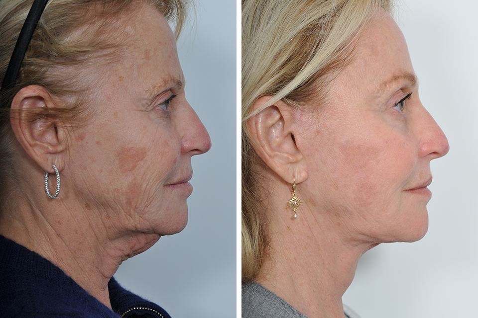 Facelift case #3852