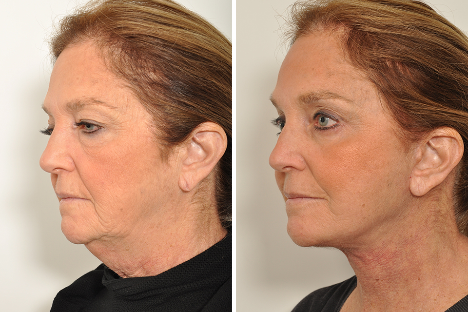 Brow Lift case #3715