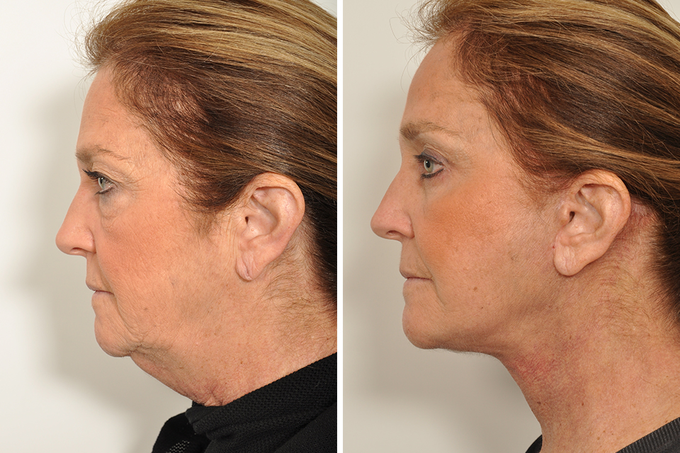 Brow Lift case #3715
