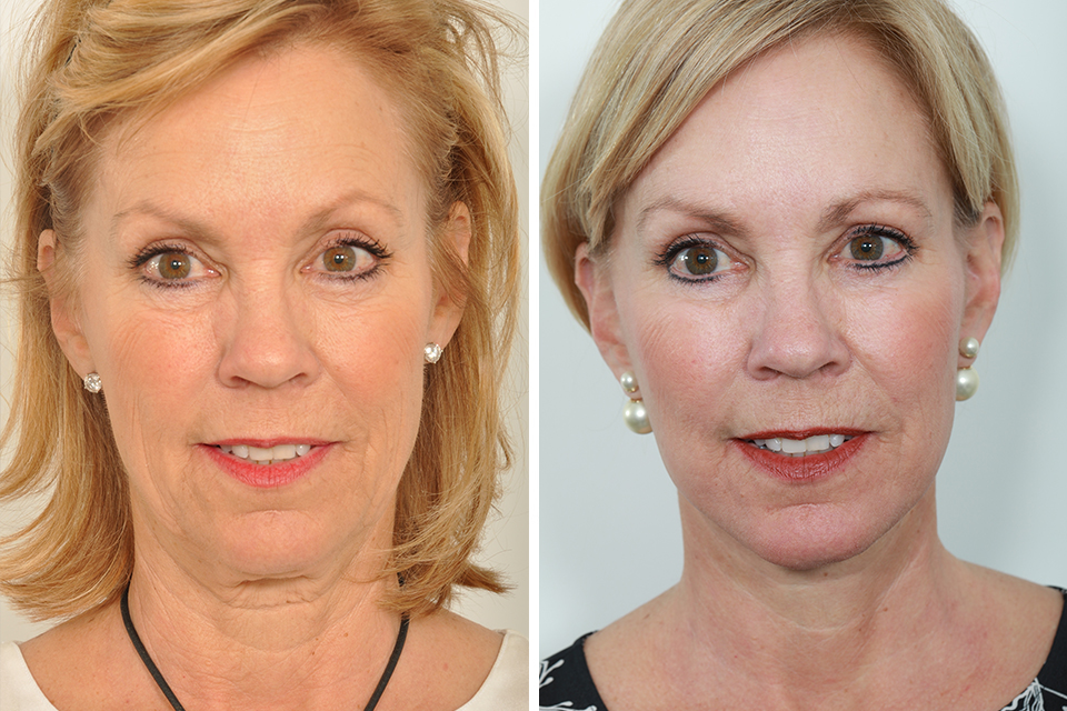 Facelift case #3849