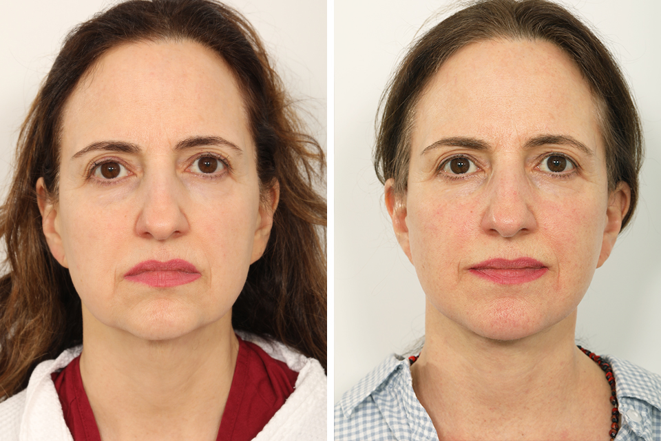 Facelift case #3862