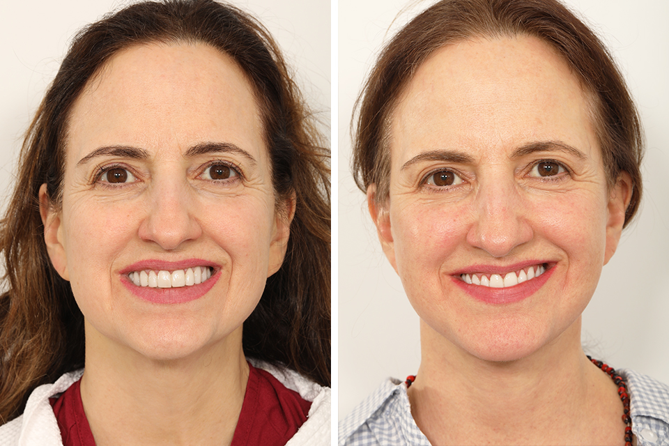 Facelift case #3862