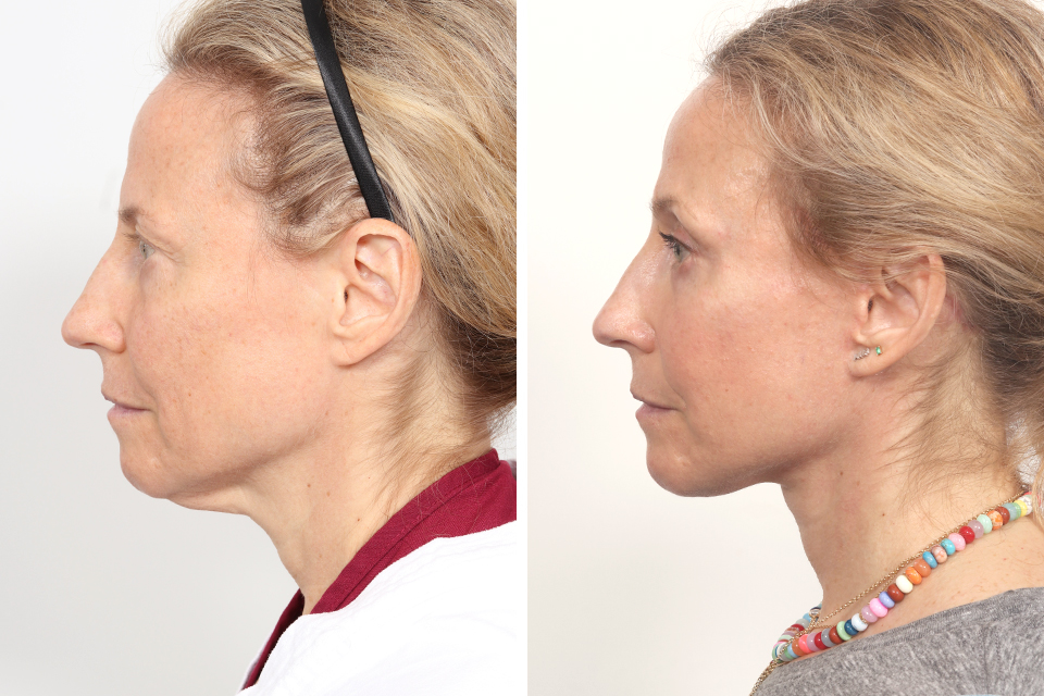 Blepharoplasty case #3766