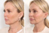 Facelift case #3760 slider thumbnail