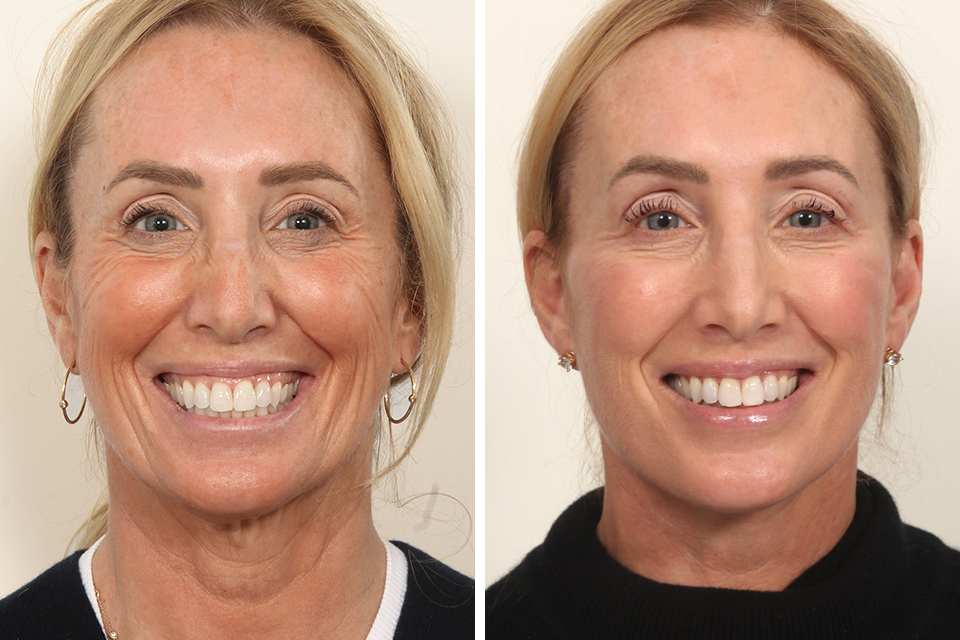 Facelift case #3769