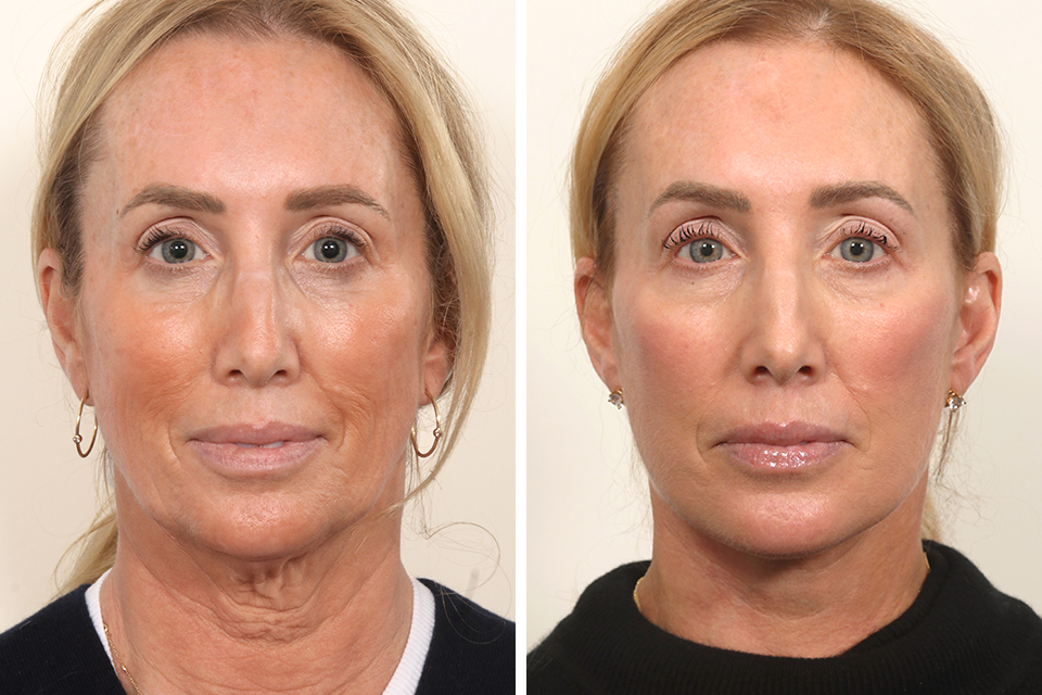 Facelift case #3769