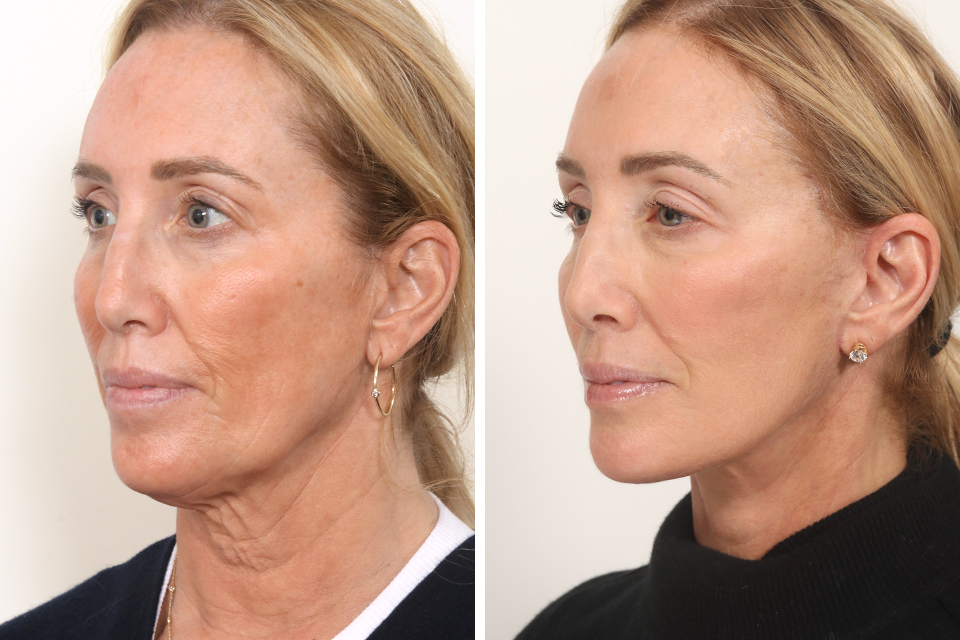 Facelift case #3769