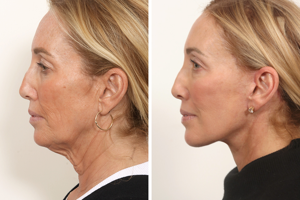 Facelift case #3769