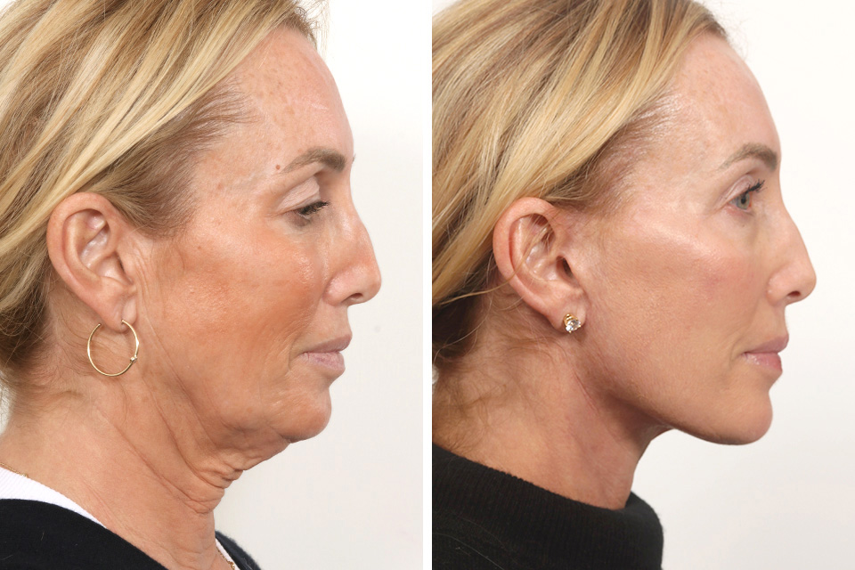 Facelift case #3769