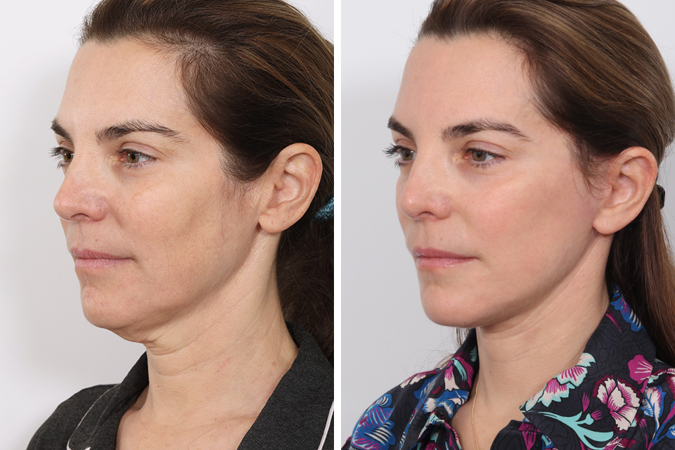Facelift case #3776