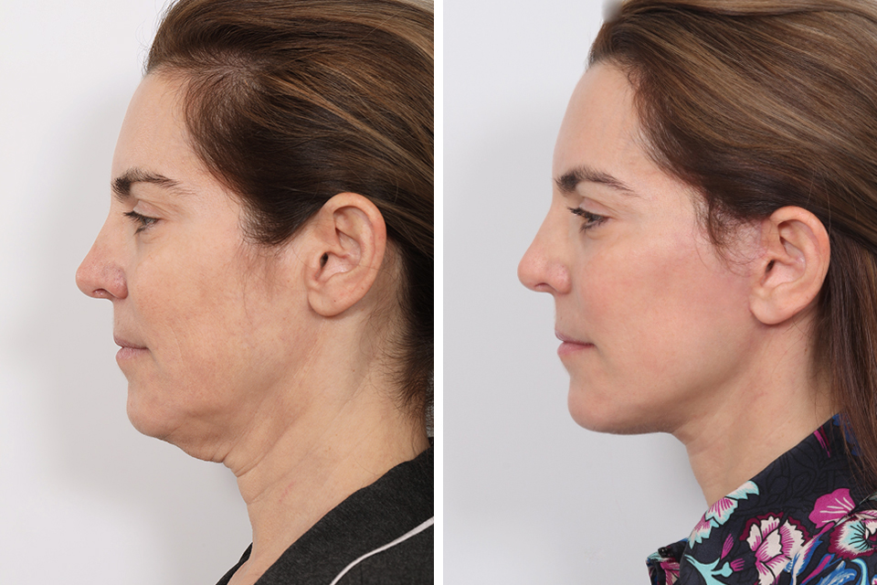 Facelift case #3776