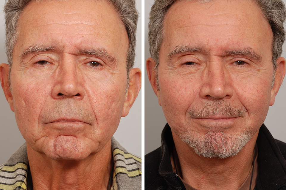 Facelift case #3438