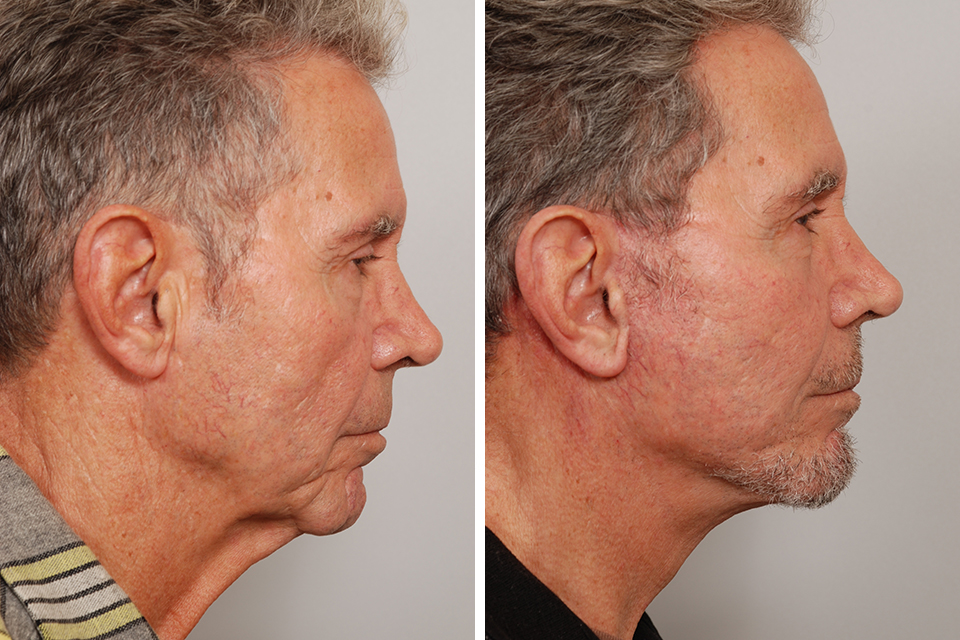 Facelift case #3438