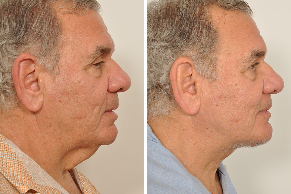 Facelift case #3450