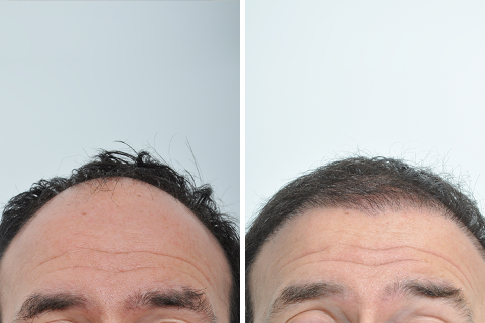 Hair Restoration case #3476