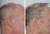 Hair Restoration case #3468 slider thumbnail