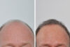 Hair Restoration case #3452 slider thumbnail