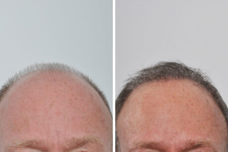 Hair Restoration case #3452
