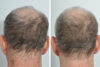 Hair Restoration case #3468 slider thumbnail
