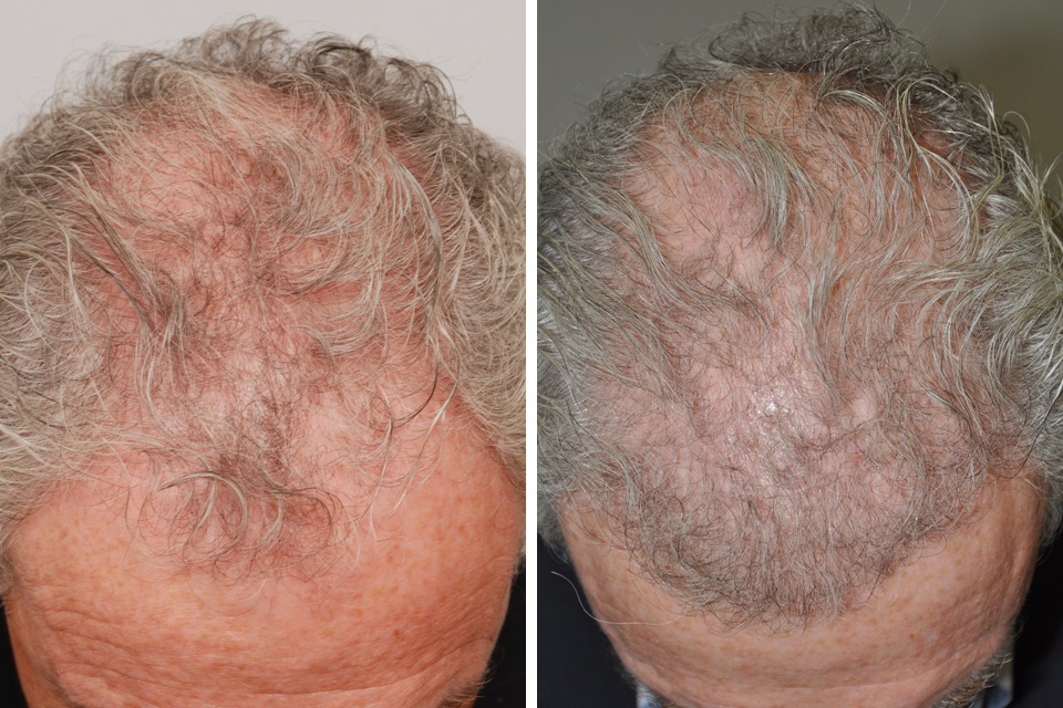Hair Restoration case #3481