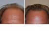 Hair Restoration case #3462 slider thumbnail