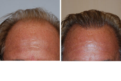 Hair Restoration case #3462