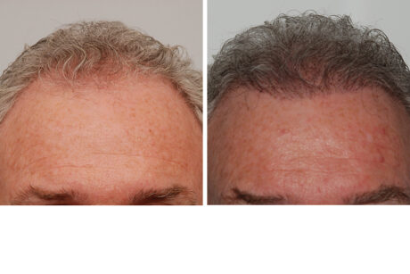 Hair Restoration case #3479