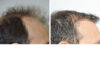 Hair Restoration case #3476 slider thumbnail